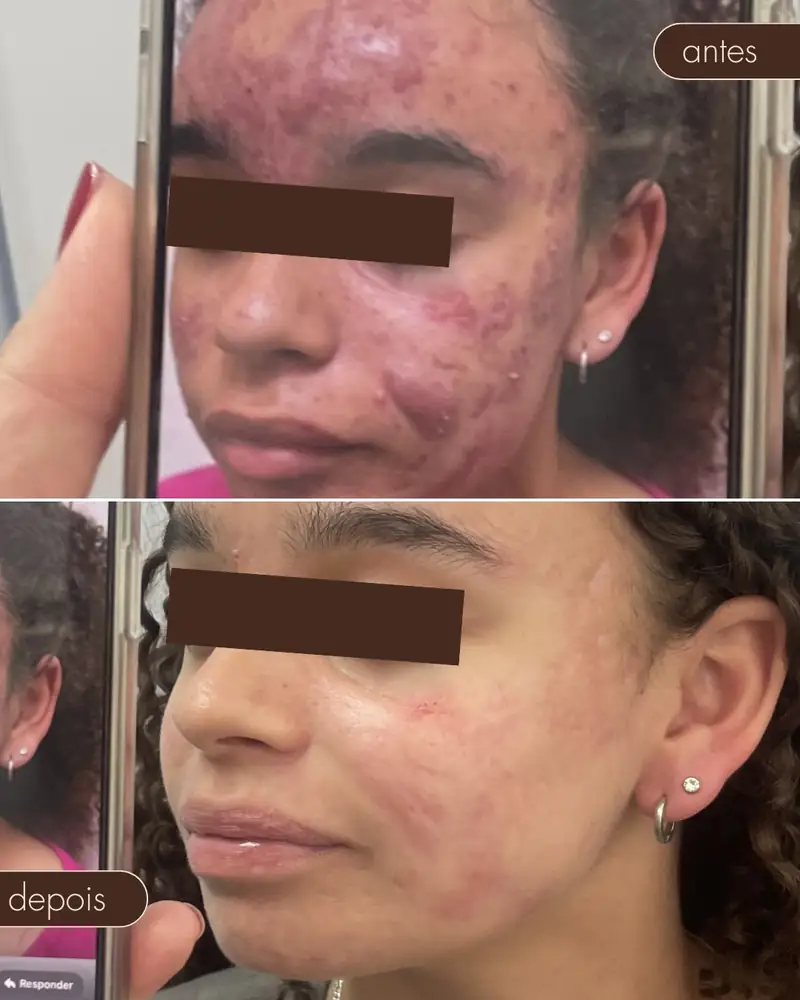Antes e depois — Tratamento de acne